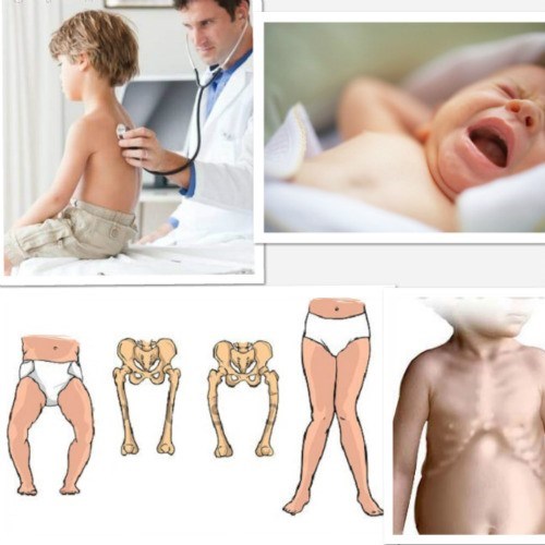 Cảnh báo bệnh còi xương ở trẻ các bậc cha mẹ nên biết.